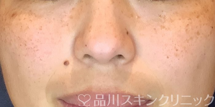 症例NO.69379のBEFORE写真