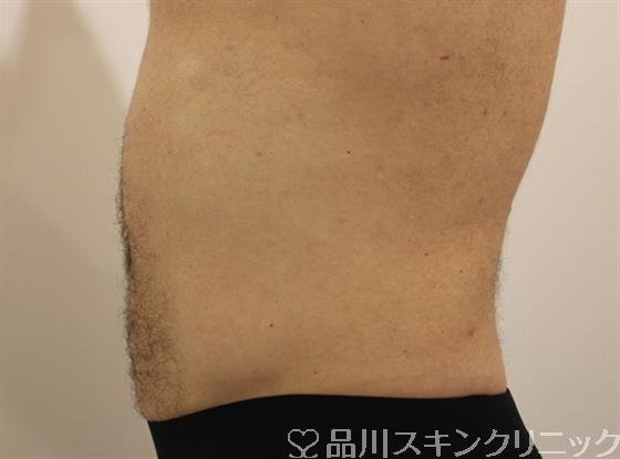 症例NO.48218のBEFORE写真
