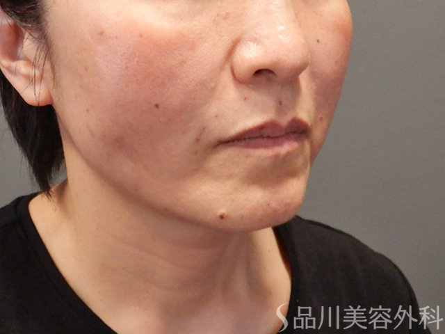 症例NO.74390のAFTER写真