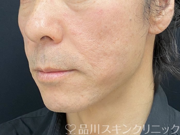 症例NO.74973のAFTER写真