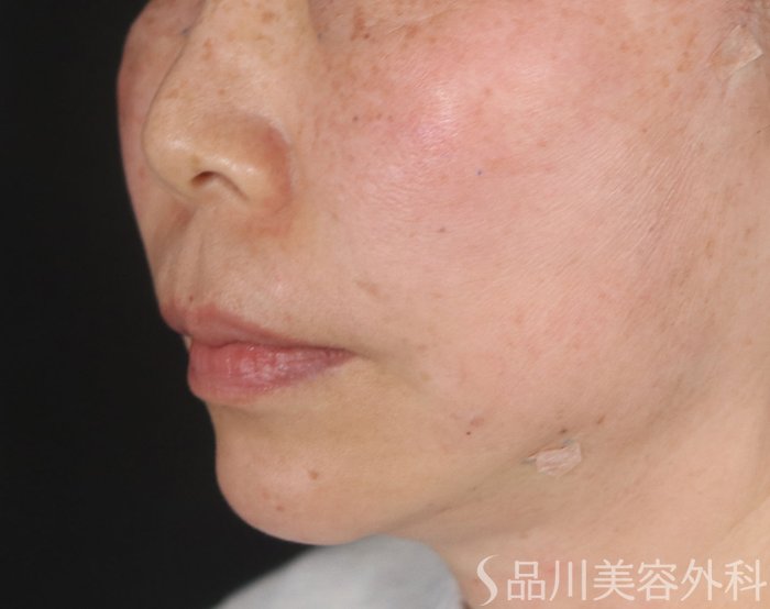 症例NO.72915のAFTER写真