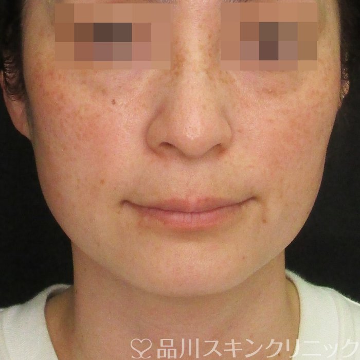症例NO.75212のBEFORE写真