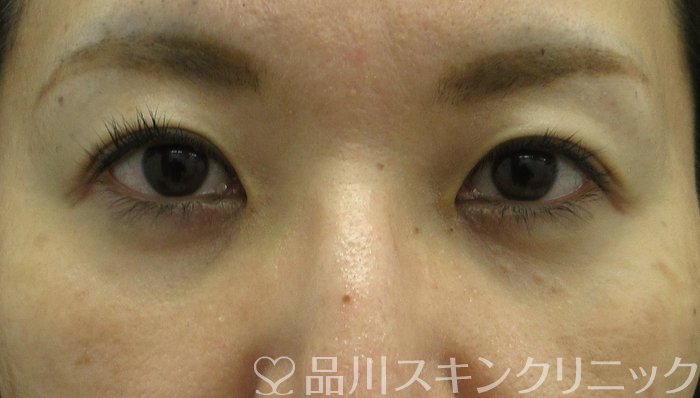 症例NO.71321のAFTER写真