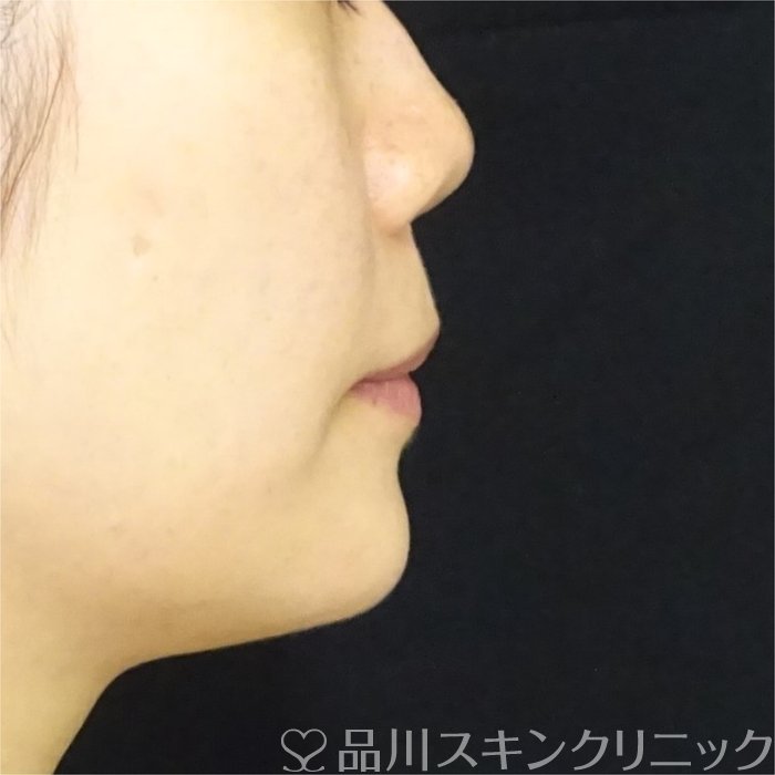 症例NO.69449のAFTER写真