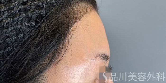 症例NO.66205のBEFORE写真