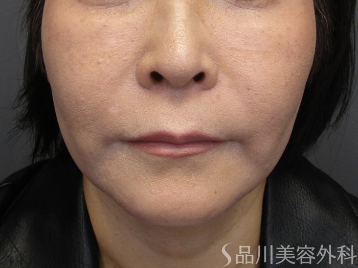 症例NO.75185のBEFORE写真