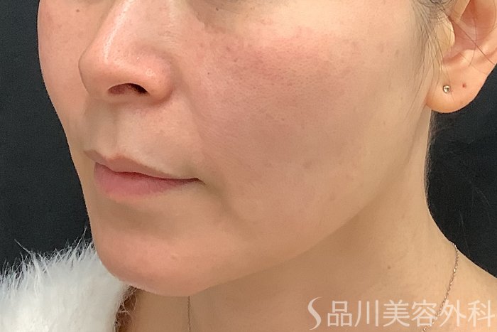 症例NO.73322のBEFORE写真