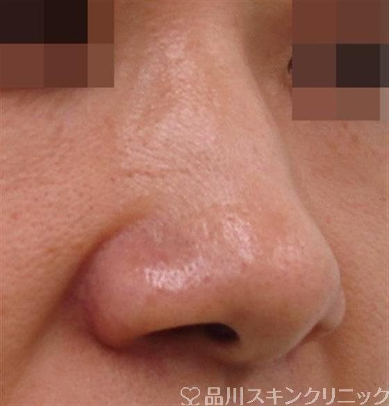 症例NO.38476のBEFORE写真