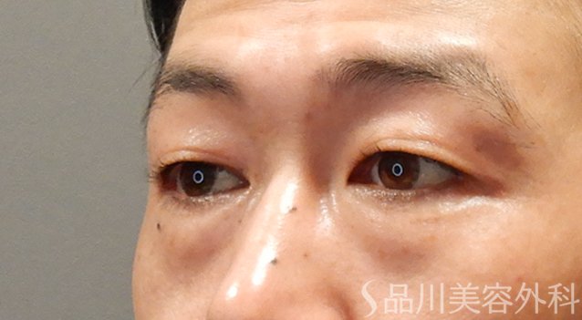症例NO.74900のBEFORE写真