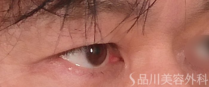 症例NO.69360のBEFORE写真