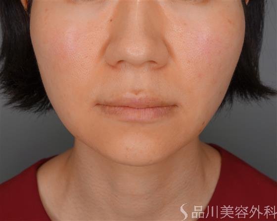 症例NO.53883のBEFORE写真