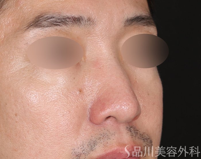 症例NO.71673のBEFORE写真