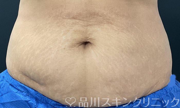 症例NO.74680のBEFORE写真