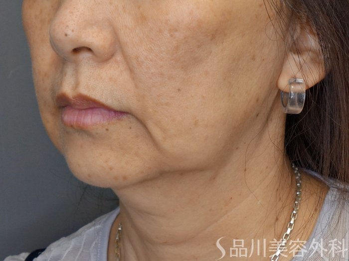 症例NO.70472のBEFORE写真