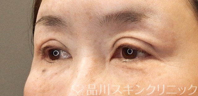 症例NO.67257のAFTER写真