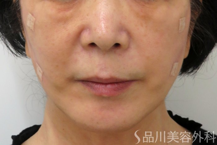 症例NO.74808のAFTER写真