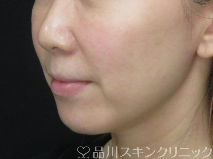 症例NO.69931のBEFORE写真