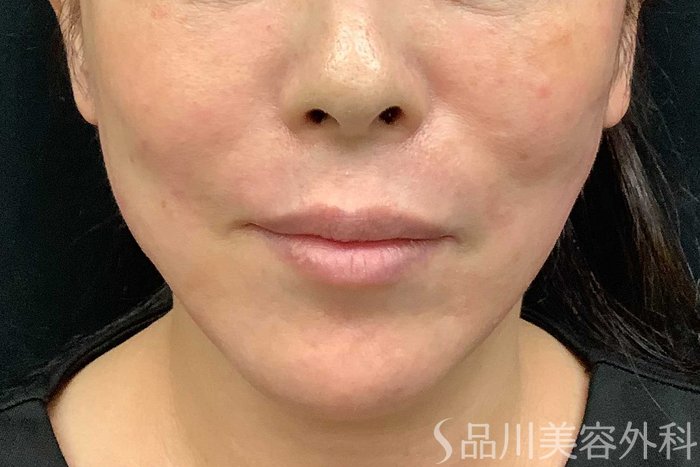 症例NO.69706のAFTER写真
