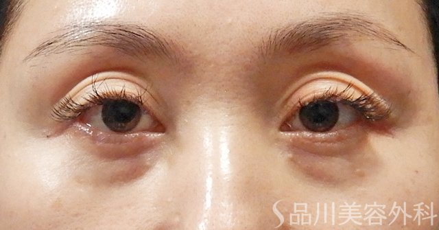 症例NO.65367のBEFORE写真