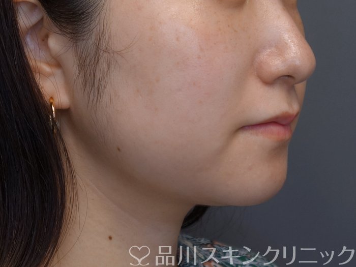 症例NO.75079のAFTER写真