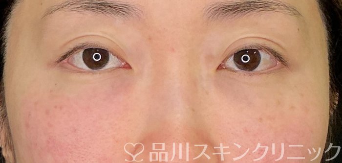 症例NO.74914のAFTER写真
