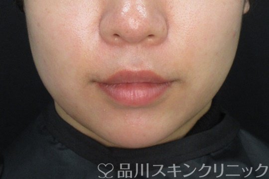 症例NO.73177のAFTER写真