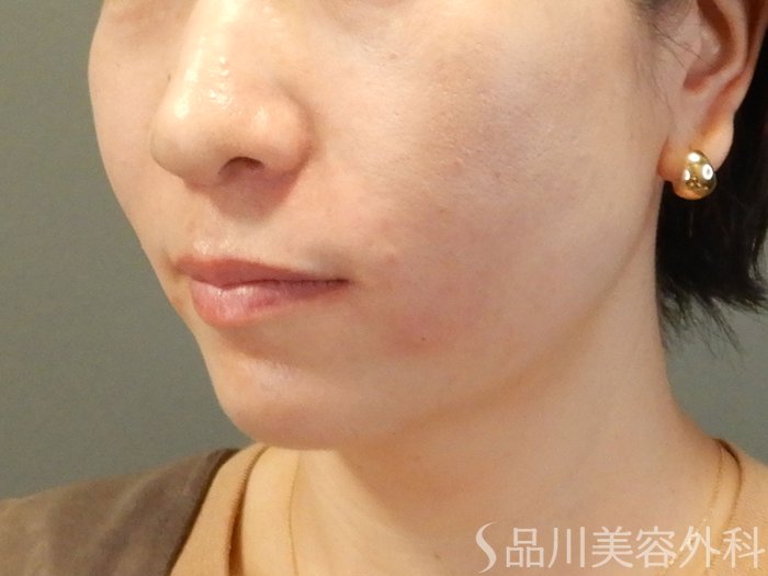 症例NO.62408のAFTER写真