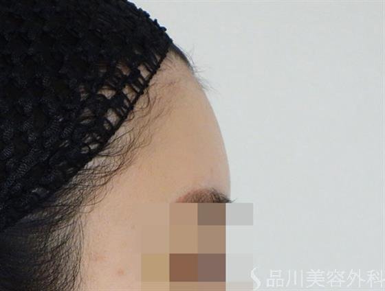 症例NO.47181のAFTER写真