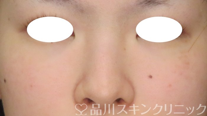 症例NO.74023のBEFORE写真