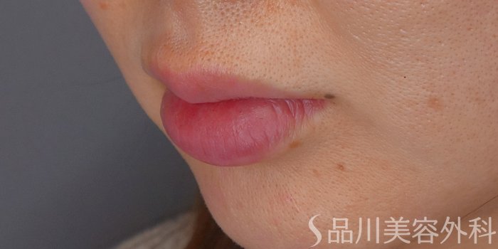 症例NO.72337のAFTER写真