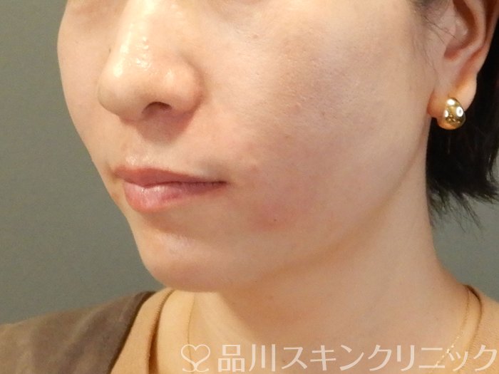 症例NO.62408のAFTER写真