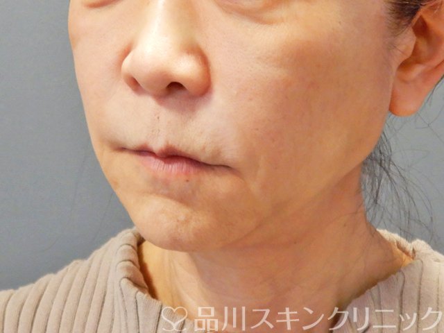 症例NO.68573のAFTER写真