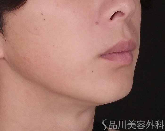 症例NO.74330のBEFORE写真