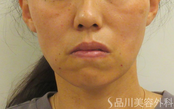 症例NO.71956のAFTER写真