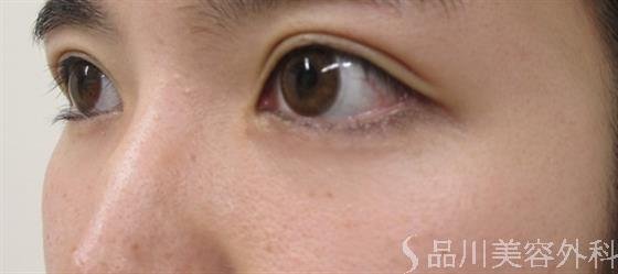 症例NO.35855のAFTER写真