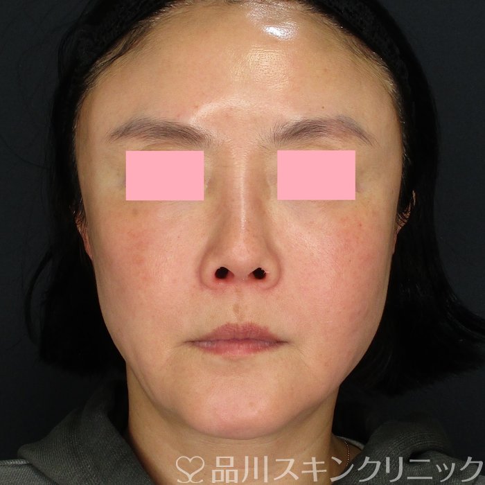 症例NO.74053のBEFORE写真