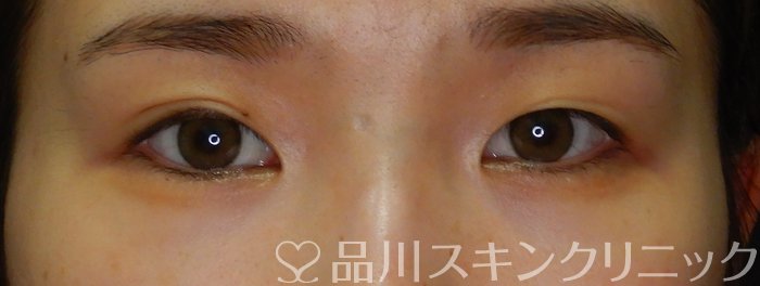 症例NO.63567のBEFORE写真