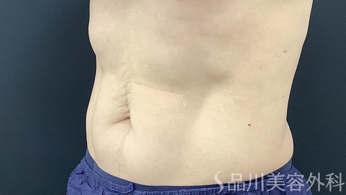 症例NO.75386のAFTER写真