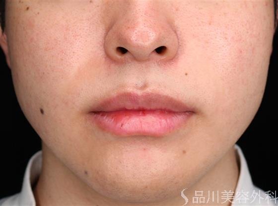 症例NO.61890のAFTER写真