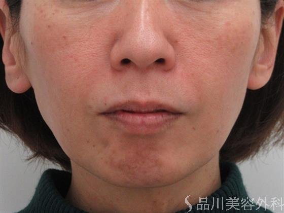 症例NO.26321のAFTER写真