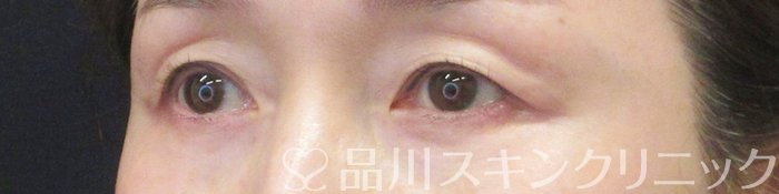 症例NO.62898のBEFORE写真