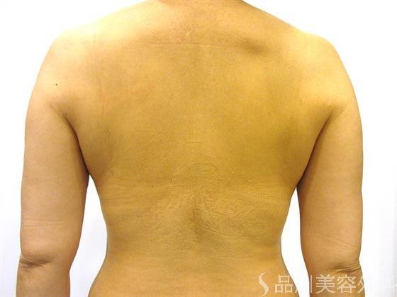 症例NO.22901のAFTER写真