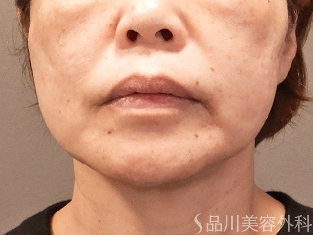 症例NO.72505のAFTER写真