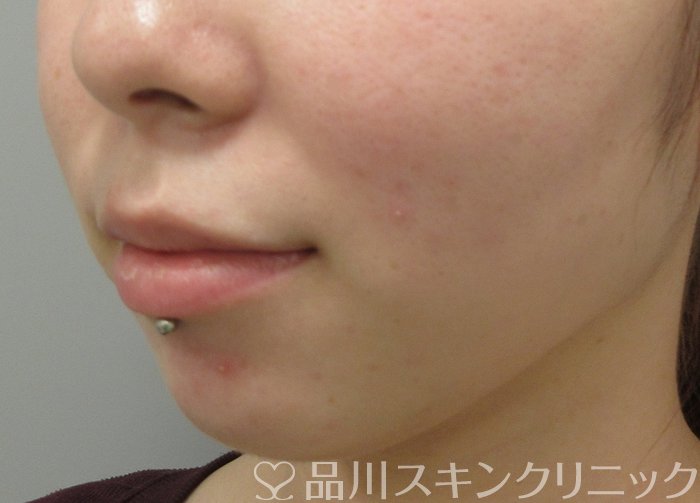 症例NO.70218のBEFORE写真