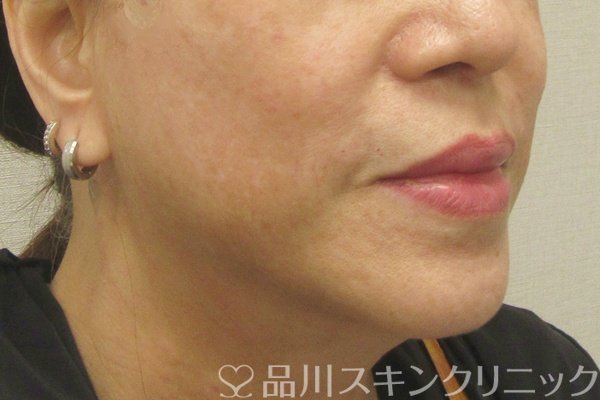 症例NO.75224のAFTER写真