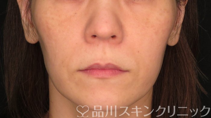 症例NO.70954のBEFORE写真