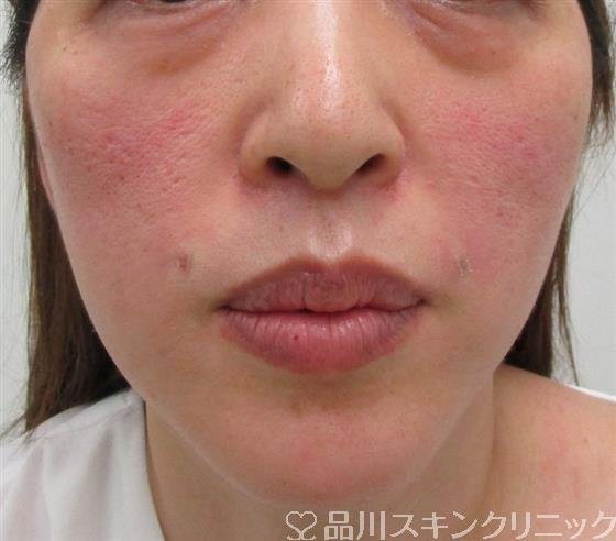 症例NO.30719のAFTER写真
