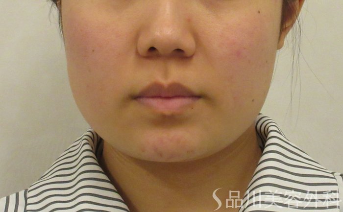 症例NO.71710のBEFORE写真