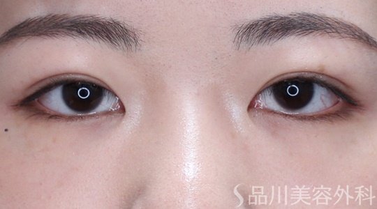 症例NO.69676のAFTER写真