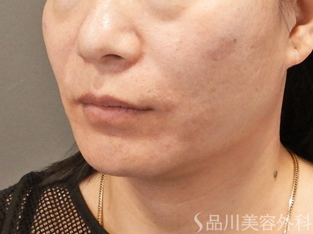 症例NO.75133のAFTER写真